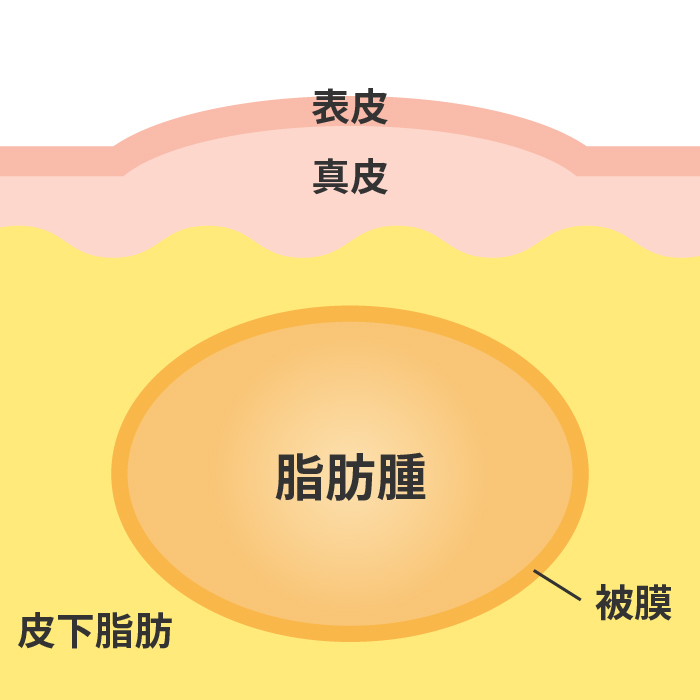 脂肪腫とは