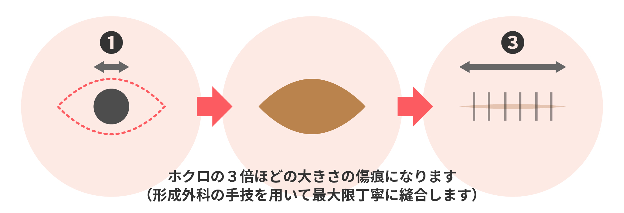 ホクロの3倍ほどの大きさのキズ痕になります(形成外科の手技を用いて最大限丁寧に縫合します)