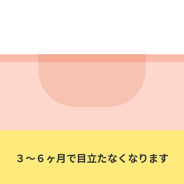 3〜6ヶ月で目立たなくなります