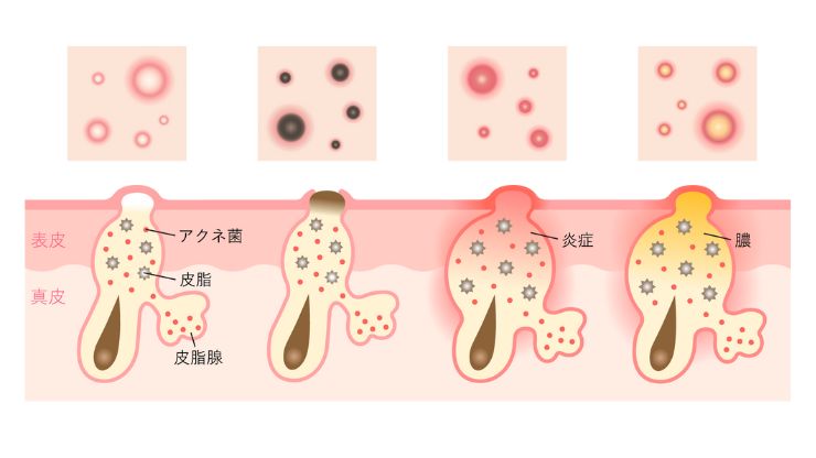 ニキビの種類