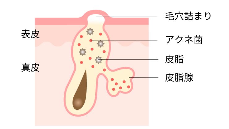 白ニキビ