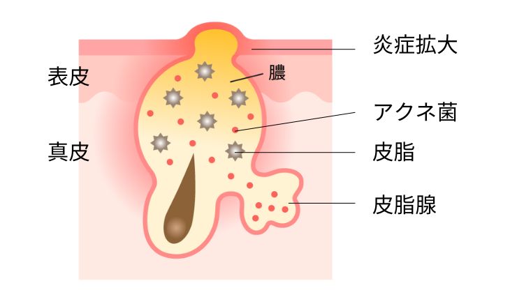 黄ニキビ