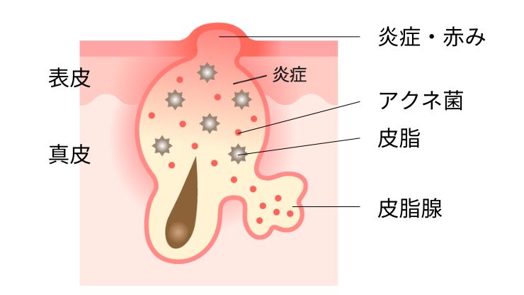 赤ニキビ